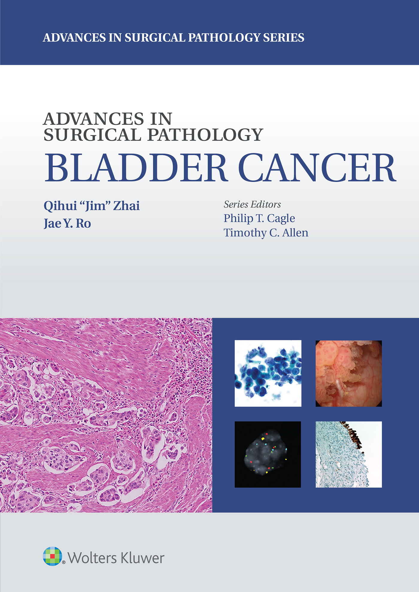 Рак мочевого пузыря психосоматика. Bladder Pathology.